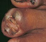 Thumbnail of Fourth toe of a 50-year-old women. The nail is lifted up by a lesion. An abcess has formed near the nail wall, and the toe is distorted because of intense edema.