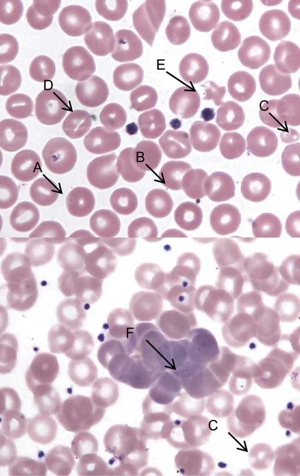 Peripheral blood film, Wright stain, 1,000× (oil immersion). A, spherostomatocyte with suspect intracellular organism; B, suspect membrane-associated organism; C, microcytes with punctate discoloration; D, stomatocyte; E, poikilocyte with punctate discoloration and suspected membrane associated organism; and F, aggregate of polychromatophilic erythrocytes and suspect intracellular organism at tip of arrow.