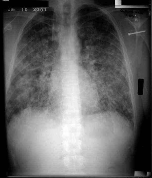 Chest radiograph of patient who acquired acute pulmonary histoplasmosis after visiting a cave in Nicaragua.