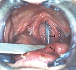 Thumbnail of Nasogastric tube embedded in the nasopharynx. 1, nasogastric tube; 2, dorsum of tongue.