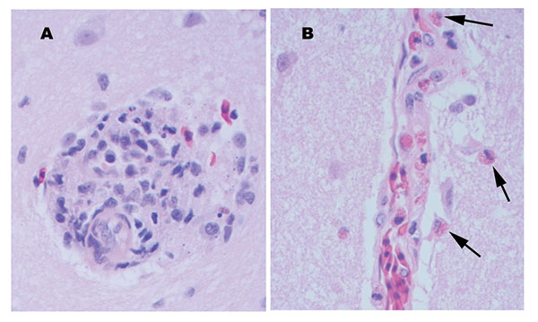 Perivascular changes observed within the brain of alligators infected with West Nile virus (400x). A. Perivascular infiltrates were composed of primarily lymphocytes, plasma cells, and macrophages in the hatchling alligator. B. Perivascular infiltrates were composed of primarily heterophils (arrows) in juvenile alligators.