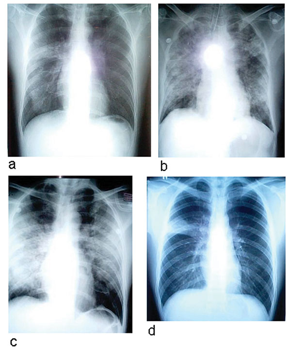 Chest radiographs of two patients with severe acute respiratory syndrome (SARS). a–c: radiographs of patient 5 showing progression of changes. a, day 8 of symptoms; b, day 13 of symptoms, d, day 14 of symptoms. He died on day 19 of this illness. d, chest radiograph, taken on day 8 of symptoms, of patient 12, with right upper lobe infiltrates resembling pulmonary tuberculosis (TB) but laryngeal swab cultures for TB were negative.