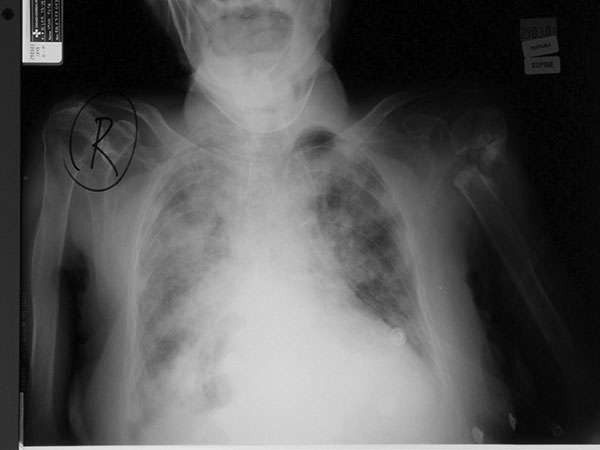 Repeat chest radiograph as second admission.