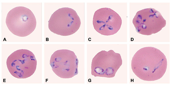 Panel of Babesia-infected erythrocytes photographed from pretreatment, Wrights-Giemsa–stained smears of fresh blood obtained from the patient on July 31, 2002. The mean corpuscular volume of the erythrocytes was 103 (normal range 80–100 μm3). Note the multiply infected erythrocytes; the pleomorphism of the parasite; and the obtuse (divergent) angle formed by some of the paired structures, which, like the form in (F), is characteristic of B. divergens and related parasites isolated from various w