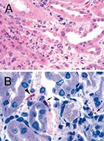 Thumbnail of A: Renal biopsy shows inflammatory cell infiltrate in the interstitium and focal denudation of tubular epithelial cells. Hematoxylin and Eosin; original magnifications x100. B: Immunostaining of fragmented leptospire (arrowhead) and granular form of bacterial antigens (arrows). Original magnifications x158.