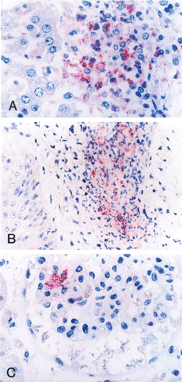 Immunohistochemical localization of spotted fever group rickettsial antigens in various tissues of a patient with fatal spotted fever rickettsiosis, by immunoalkaline phosphatase stain with naphthol phosphate–fast red substrate and hemotoxylin counterstain. Rickettsiae and rickettsial antigens (red) in Kupffer cells in liver (A), perivascular infiltrates in skin (B), and glomerular endothelium in kidney (C) (naphthol–fast red stain with hematoxylin counterstain; original magnifications x158).
