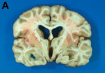 A) Coronal section of brain showing dilation of ventricles, flattening of the cerebral gyri, and uncal herniation. B) Intact cysticercus occupying the 4th ventricle