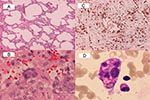 Thumbnail of Histopathologic findings of lung biopsy (patient 1) and bone marrow biopsy (patient 2) in two patients with severe acute respiratory syndrome. A: diffuse interstitial pneumonitis with mononuclear cell infiltrating in the mildly thickened alveolar septum (hematoxylin and eosin stain, X100). B: desquamated, multinucleated syncytial giant cell without cytoplasmic inclusion (hematoxylin and eosin stain, X400). C: abundant CD68-positive histiocytes (X100). D: a macrophage ingested with e