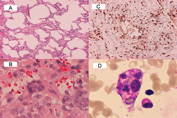 Histopathologic findings of lung biopsy (patient 1) and bone marrow biopsy (patient 2) in two patients with severe acute respiratory syndrome. A: diffuse interstitial pneumonitis with mononuclear cell infiltrating in the mildly thickened alveolar septum (hematoxylin and eosin stain, X100). B: desquamated, multinucleated syncytial giant cell without cytoplasmic inclusion (hematoxylin and eosin stain, X400). C: abundant CD68-positive histiocytes (X100). D: a macrophage ingested with erythrocytes,