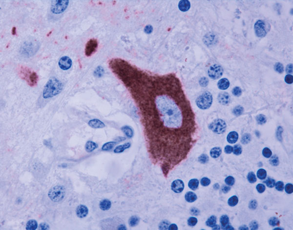 Staining of West Nile virus antigen in the cytoplasm of a Purkinje cell in the cerebellum. Immunohistochemistry. 40x.