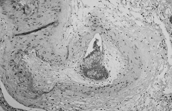 Proliferative endarteritis. The artery is stenotic and partially occluded by fibrous tissue. The residual lumen is almost completely occupied by recent thrombus (frontal lobe, x160, stained with hematoxylin and eosin–Luxol-fast blue).