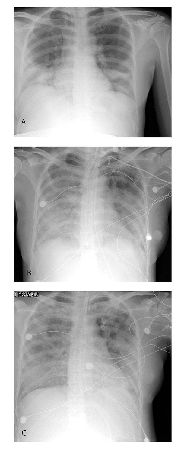 Chest radiographs of case-patient with severe acute respiratory syndrome (SARS) while pregnant. a, day 6 of illness; b, day 10; c, day 13.