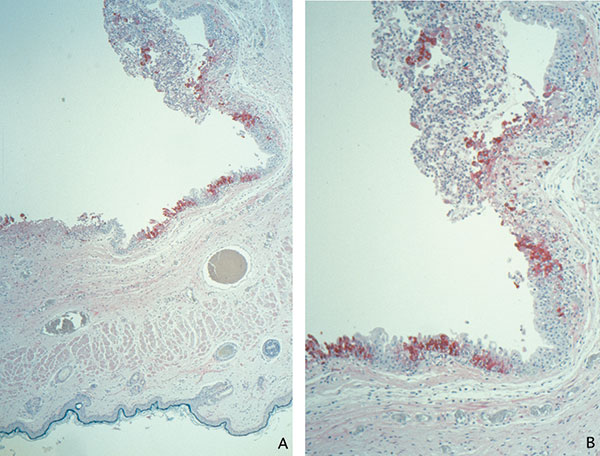 Immunohistochemical staining of a prairie dog eyelid infected with monkeypox virus, showing orthopox virus antigen staining of the cytoplasm of the epithelium of the palpebral conjunctivae (assay using anti–variola virus antibody; original magnifications: A, 12.5X; B, 25X).