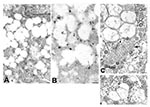 Thumbnail of Ultrastructural characteristics of double-membrane vesicles. A) Immunogold labeling of viral proteins by using hyperimmune mouse ascitic fluid (12 nm gold) in areas of cytoplasm in close proximity to the double-membrane vesicles. B) Ultrastructural in situ hybridization detection of viral mRNA, genRNA, or both (6 nm gold) in the same areas and also at times associated with diffuse granular material within the double-membrane vesicles. C) Double-membrane vesicles showing several sing