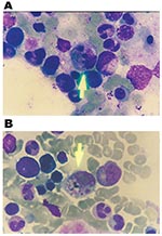 Thumbnail of Bone marrow aspiration smear, stained with Wright, showing hemophagocytosis. A) shows phagocytosis of an erythrocyte and nuclear remnants by macrophance. B) shows phagocytosis of platelets by a macrophage.