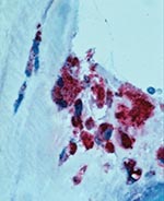 Thumbnail of Immunohistochemical localization of Coxiella burnetii antigens in the aortic valve of a patient co-infected with HIV. Intact bacteria and fragment antigens are identified predominantly within macrophages in the fibrosed and calcified valve tissue. (Immunoalkaline phosphatase stain with naphthol phosphate fast-red substrate and hematoxylin counterstain, original magnification X100).