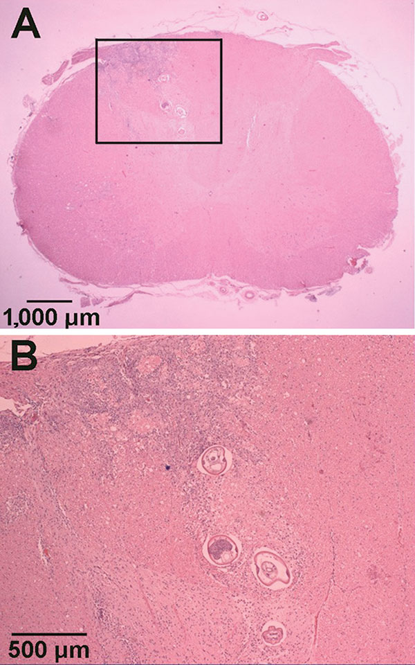 Hematoxylin and eosin–stained sections of Parastrongylus cantonensis in the parenchyma of the cervical spinal cord of a gibbon (Hylobates lar) from Florida (A). Enlarged image of inset from panel A (B).