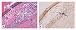 Thumbnail of Covert Taura syndrome virus (TSV) infection (transition/chronic phase of TS disease) in indicator specific pathogen free–Litopenaeus vannamei shrimp was confirmed by in situ hybridization (ISH) with digoxigenin-labeled gene probes specific for detection of TSV. A) Histologic section through the dorsal cuticular epithelium showing a melanized resolving lesion (MZ) and hemolytic congestion (HCg), indicative of the transition phase of TSV infection (hematoxylin/eosin-phloxin stain; 50x