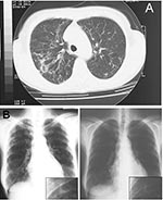 Thumbnail of A) Pulmonary computed tomographic scan representation of Mycobacterium lentiflavum lesions. Radiologic image shows the appearance of a widespread reticulonodular alteration and an opacity in the left middle lobe. B) Chest radiograph evolution after 3 months of treatment shows a sustained improvement of the radiologic alterations to the left pulmonary middle lobe.