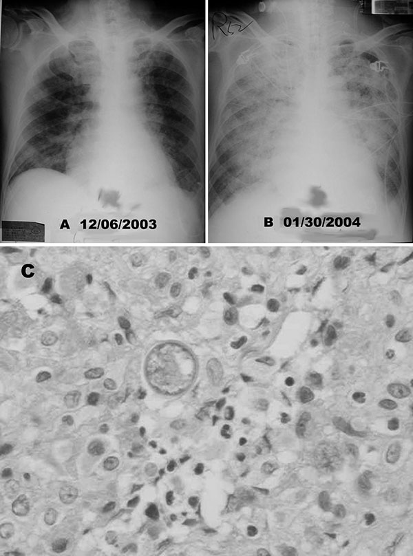 A) Chest radiograph shows diffuse nodular lesions in both lungs. B) Chest radiographic scan taken 2 months later shows coalescence of nodular shadows and almost complete white-out of bilateral lung fields. C) Hematoxylin and eosin staining of the wound specimen from pleural biopsy site showed spherules of Coccidioides immitis and chronic necrotizing granulomatous inflammation (400x).