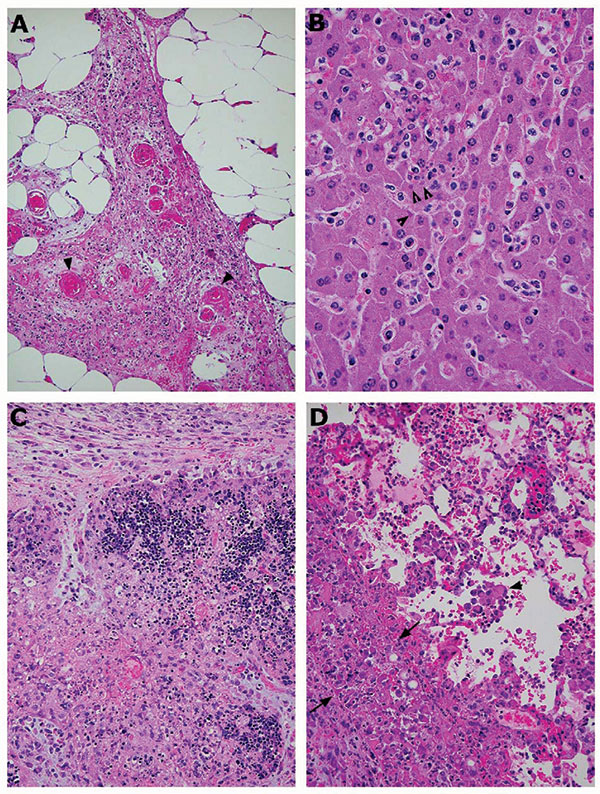 Photomicrographs of pathologic changes in tissues of prairie dogs infected with monkeypox virus. A) Abdominal adipose tissue from an intraperitoneally infected animal showing focal vasculitis (arrowheads), necrosis, and proliferation of fibroblasts. B) Mild hepatitis, characterized by focal inflammatory cell infiltration in the lobules and hepatocytes containing cytoplasmic inclusion bodies (arrowheads). C) Severe necrosis of the thymus from an animal infected intranasally. The necrotic areas co