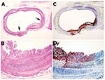 Thumbnail of Bronchus from animal MPX-9, which was infected intranasally. A) Cross-section of a bronchus, showing focal metaplasia and proliferation (between the arrows) of the luminal epithelium. B) Higher magnification showing the details of the metaplastic epithelium, accompanied by focal necrosis. Compare to the adjacent unaffected area, which is lined by normal ciliated columnar epithelial cells. C and D) Immunohistochemical staining of the corresponding field shows presence of viral antige