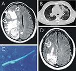 Thumbnail of Chrysosporium sp. brain abscess in an HIV-seropositive patient. A) T2-weighted magnetic resonance imaging (MRI) scan of the brain showing 2 large masses (triangle) surrounded by a ring of signal intensity and extensive perifocal edema (open arrows), global swelling of the right hemisphere, and a midline shift of 1.2 cm. B) Computed tomographic scan of the chest showing infiltration of the left and right lower segment. C) Mold mycelium in aspirate of brain abscess using calcoflour wh