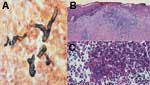 Thumbnail of Biopsied section of the lesion: A) branch and broad hyphal fragment of Pythium insidiosum (Gomori methemine silver, magnification ×200); B) hyphal fragment surrounded by inflammatory cells (hematoxylin and eosin [HE], magnification ×200); C) hyphal fragment surrounded by eosinophilic material, which suggests a Splendore-Hoeppli phenomenon (HE, magnification ×200).