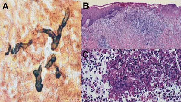 Biopsied section of the lesion: A) branch and broad hyphal fragment of Pythium insidiosum (Gomori methemine silver, magnification ×200); B) hyphal fragment surrounded by inflammatory cells (hematoxylin and eosin [HE], magnification ×200); C) hyphal fragment surrounded by eosinophilic material, which suggests a Splendore-Hoeppli phenomenon (HE, magnification ×200).