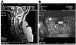 Thumbnail of Saggital (A) and axial (B) T2-weighted magnetic resonance images of the cervical spinal cord in a patient with acute asymmetric upper extremity weakness and subjective dyspnea. A shows a diffuse cervical cord signal abnormality, and B shows an abnormal signal in the anterior horn region.