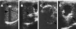 Thumbnail of Lesions of alveolar echinococcosis (AE) by abdominal ultrasound examination. A) Calcified lesion: hyperechoic structure with a typical posterior shadow. B) Nodular hyperechoic lesion. C) Typical AE lesion: nonhomogeneous hyperechoic partially calcified area, without central necrosis. D) Typical AE lesion with central necrosis.