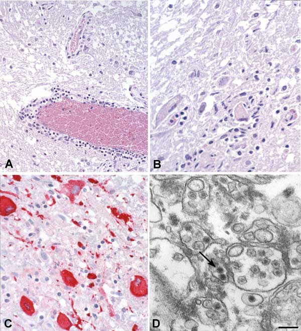 Histopathologic features of West Nile virus (WNV) in human tissues. Panels A and B show inflammation, microglial nodules, and variable necrosis that occur during WNV encephalitis; panel C shows WNV antigen (red) in neurons and neuronal processes using an immunohistochemical stain; panel D is an electron micrograph of WNV in the endoplasmic reticulum of a nerve cell (arrow). Bar = 100 nm.