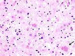 Thumbnail of Histopathologic changes in frontal cerebral cortex of the patient who died of variant Creutzfeldt-Jakob disease in the United States. Marked astroglial reaction is shown, occasionally with relatively large florid plaques surrounded by vacuoles (arrow in inset) (hematoxylin and eosin stain, original magnification ×40).