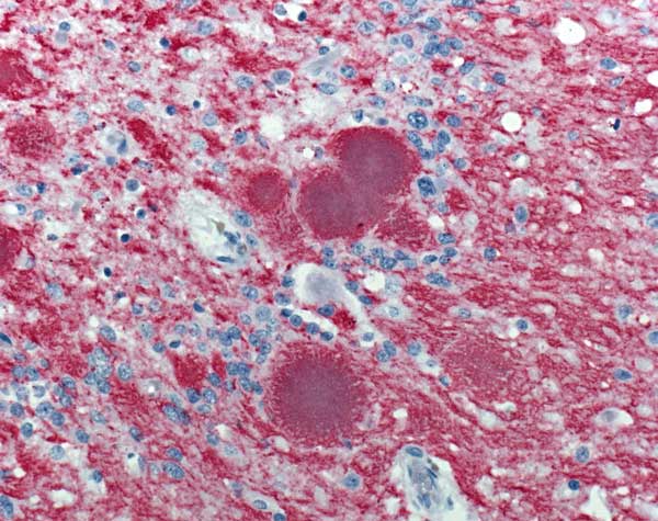 Immunohistochemical staining of cerebellar tissue of the patient who died of variant Creutzfeldt-Jakob disease in the United States. Stained amyloid plaques are shown with surrounding deposits of abnormal prion protein (immunoalkaline phosphatase stain, naphthol fast red substrate with light hematoxylin counterstain; original magnification ×158).