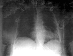 Thumbnail of Chest radiograph of the patient showing bilateral alveolar infiltrates. Although pulmonary edema was the initial diagnosis, an infectious cause should be considered and, on the basis of sepsis, appropriate treatment initiated.