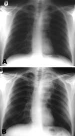 Thumbnail of Chest radiographs at initiation of A) highly active antiretroviral therapy (HAART) showing left hilar mass; and B) after 9 weeks of HAART and antituberculosis treatment, suggesting enlargement of the hilar mass consistent with immune restoration disease. (The radiograph has been flipped horizontally to aid comparison).