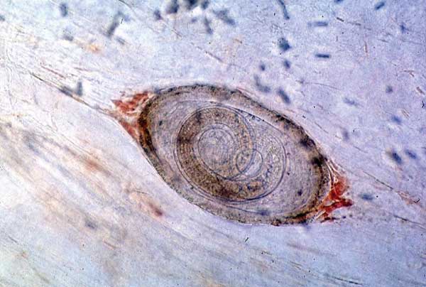 Trichinella larvae in a sample of infected meat (light microscopy, ×100).