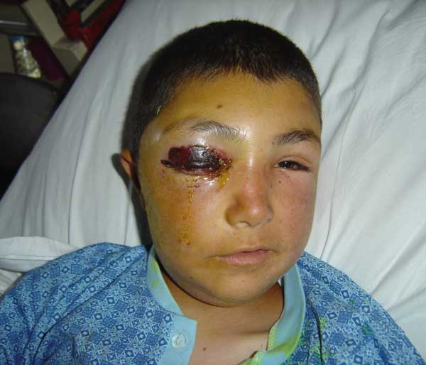 Cutaneous anthrax on eyelids. Photographer: Zülal Özkurt. Photograph taken with patient's permission.