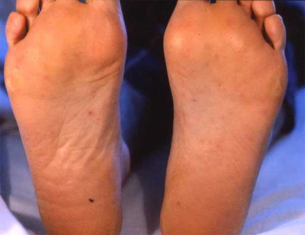 Maculopapular rash on the soles of the patient's feet.