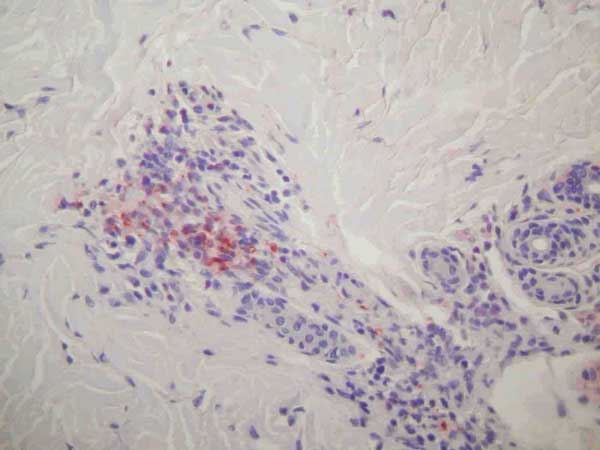 Immunohistochemical results showing rickettsiae in inflammatory infiltrates of the dermis (polyclonal rabbit anti-Rickettsia sp. antibody using a dilution of 1:1,000 and hematoxylin counterstain; original magnification ×250).