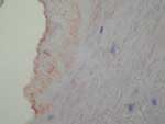 Thumbnail of Immunohistochemical demonstration of Bartonella sp. in a cardiac valve of a patient with endocarditis. Magnification ×400.