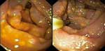 Thumbnail of Yellow plaques in the mucosa of the duodenum in patient 2. Similar lesions had been observed in patient 1 in the colon, ileum, and bladder, whereas white lesion had been described in the other AIDS patient with gastrointestinal disease (9).