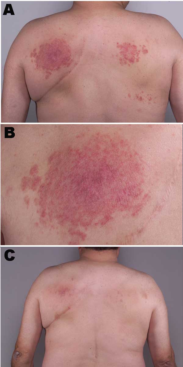 A) Appearance of rash on the patient's back at initial treatment. B) Close-up of the rash shown in panel A. C) Patient's back showing near resolution of rash after discontinuing use of the hot tub.