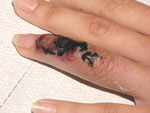 Thumbnail of Initial skin lesion with black crust and red border, suggestive of cutaneous anthrax. By the time the picture was taken, the massive edema of hand and arm had subsided.
