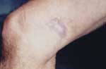Thumbnail of Erythematous-infiltrated, hypertrophic plaque with a verrucous surface ≈4 cm long in the distal third of the medical aspect of the right thigh of the patient.