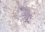 Thumbnail of Immunohistochemical detection of Rickettsia africae in the inoculation eschar of a patient with African tick-bite fever. Note the location of the bacteria in the endothelial and inflammatory cells of a blood vessel in the dermis (arrow) (monoclonal rabbit anti-R. africae antibody used at a dilution of 1:1,000 and hematoxylin counterstain; original magnification ×250).