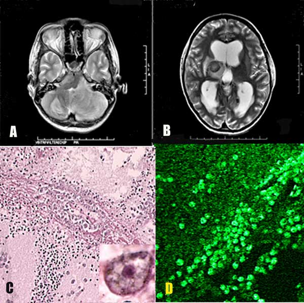 A) Magnetic resonance imaging (MRI) of the patient's brain showing a large lesion in the left cerebellar hemisphere. B) MRI in a different plane taken at the same time. Lesions are evident in the right thalamus and the right half of the pons. C) Blood vessel in brain parenchyma with large numbers of Acanthamoeba in the perivascular space (hematoxylin and eosin stained, magnification ×100). Inset, higher magnification (×1,000) showing nuclear morphology of the ameba. The dark-stained ameba nucleu