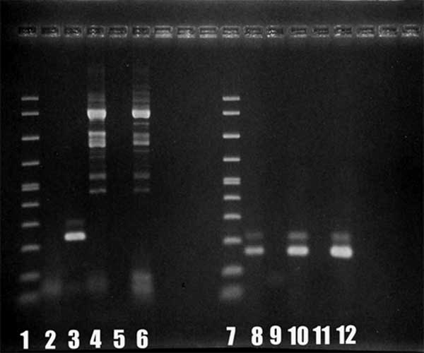 Results of polymerase chain reaction showing 230-bp and 161-bp bands for Balamuthia (lanes 1–6) and Acanthamoeba (lanes 7–12) mitochondrial 16S rRNA gene DNA. Lane 1, molecular mass marker; lane 2, absence of Balamuthia DNA in patient brain tissue (5-μL sample); lane 3, positive control (Balamuthia DNA); lane 4, negative control (Acanthamoeba DNA); lane 5, negative control (water); lane 6, absence of Balamuthia DNA in patient brain tissue (1-μL sample); lane 7, molecular mass marker; lane 8, Aca