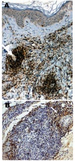 Thumbnail of A case of lymphocytoma. A) Immunohistochemical image with anti-CD20 antibody showing a nodule with a dense B-lymphocytes infiltrate in the dermis; magnification ×100. B) Immunohistochemical image with anti-CD45 Ro antibody showing T-lymphocytes at the periphery of a nodule; magnification ×250.