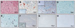 Thumbnail of Histopathologic and immunohistochemical analyses. A) Spongiform lesions; B) partially proteinase K–resistant prion protein (PrPsc) deposits detected by immunohistochemistry (monoclonal antibodies [MAb] F99/97.6.1 diluted 1:500) in the nucleus of the solitary tract (STN) in the zebu under investigation. C–E) Comparative immunohistochemistry with MAb P4 (1:800) in the olivary nuclei of the zebu (C), a bovine spongiform encephalopathy (BSE)-positive cow (D), and a scrapie-positive shee